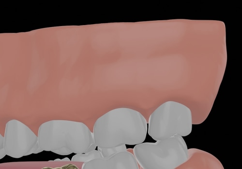 The Importance Of Quality Personal Protective Equipment During A Dental Crown Procedure In London