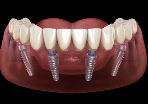 All On 4 Dental Implants And Personal Protective Equipment: Ensuring A Safe And Successful Treatment In Bexley